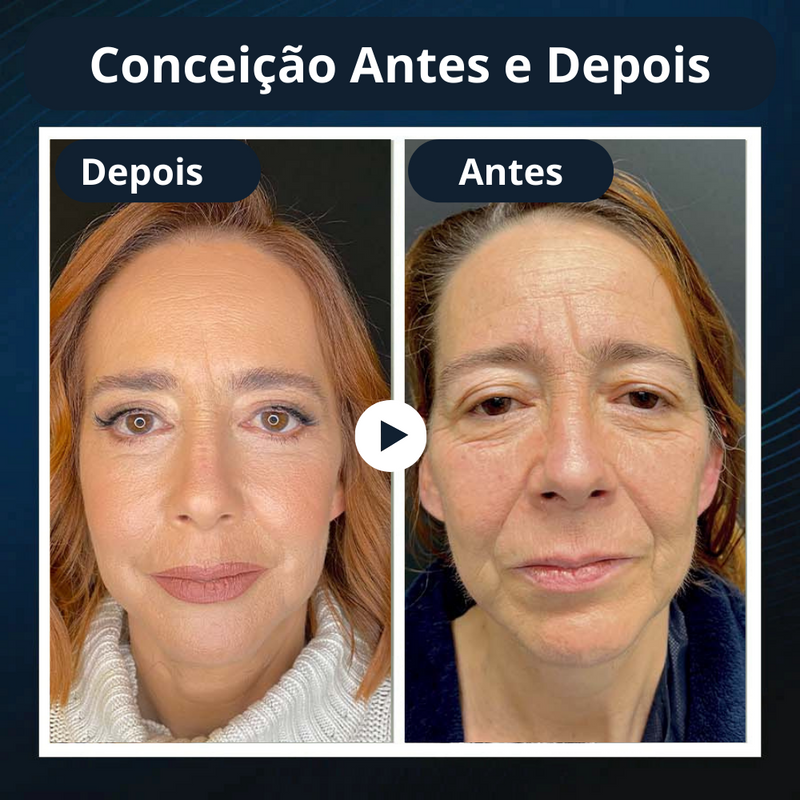 FaceSlim™ Redutor de Gordura Facial - Volte a ter um rosto Livre de Marcas de Expressão