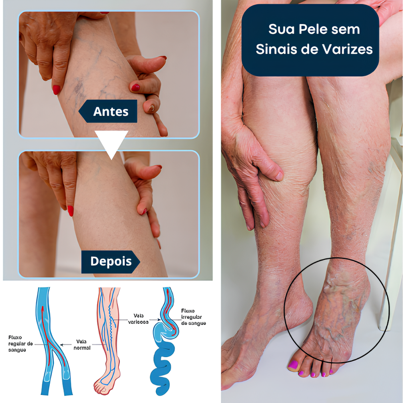 Seurico™: Reduza as Varizes e Restaure a Beleza das Suas Pernas em Apenas Algumas Semanas!