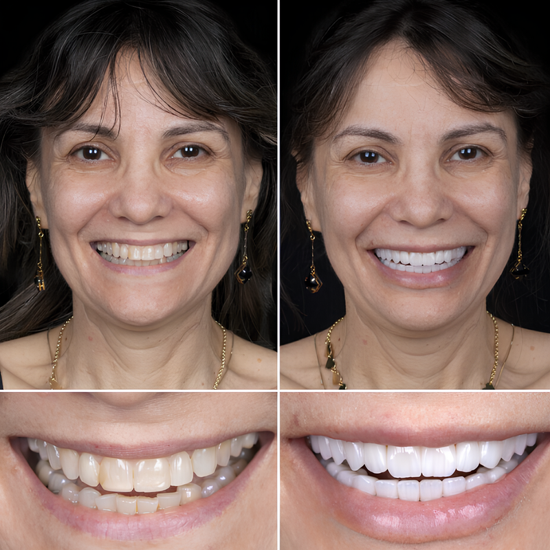 ClearSmile™ - Tratamento COMPLETO para obter DENTES BRANCOS