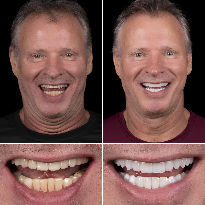 ClearSmile™ - Tratamento COMPLETO para obter DENTES BRANCOS